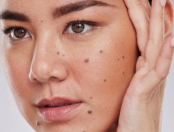 8 Cara Menghilangkan Tahi Lalat di Wajah dengan Cepat dan Mudah